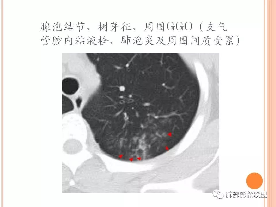 【PPT】支原体肺炎影像分析