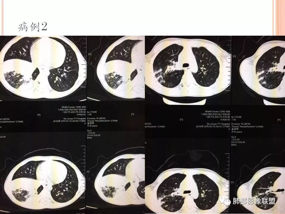 【PPT】支原体肺炎影像分析