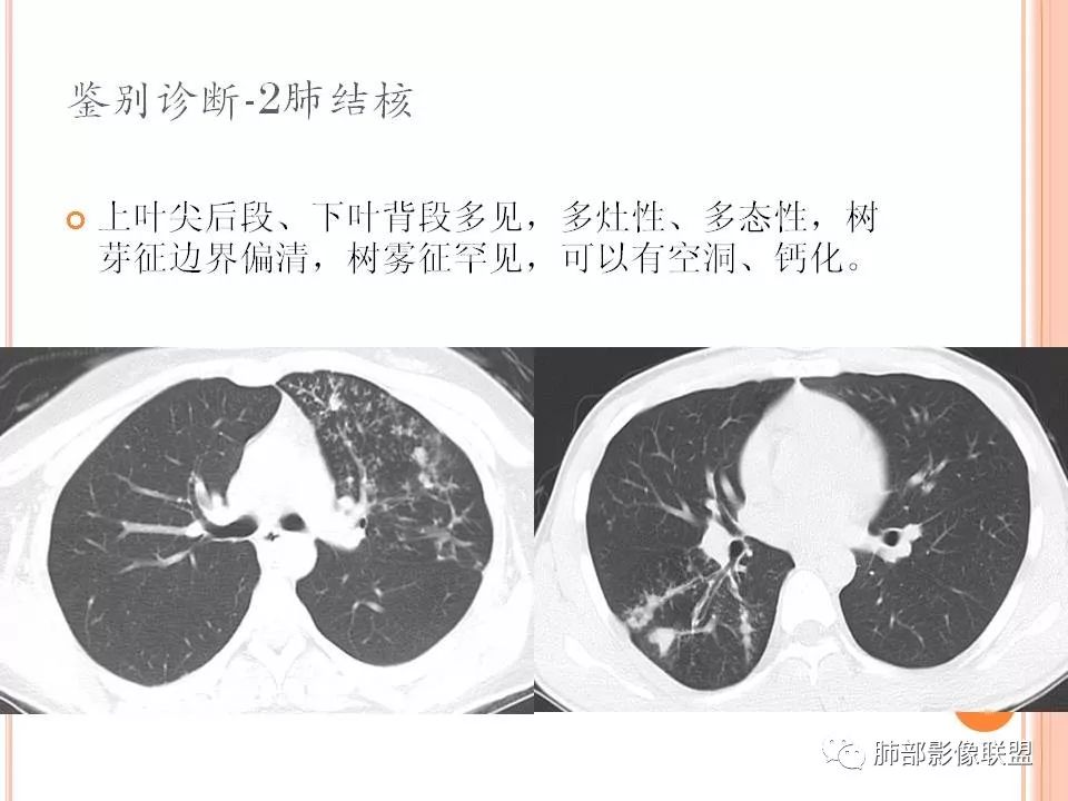 【PPT】支原体肺炎影像分析