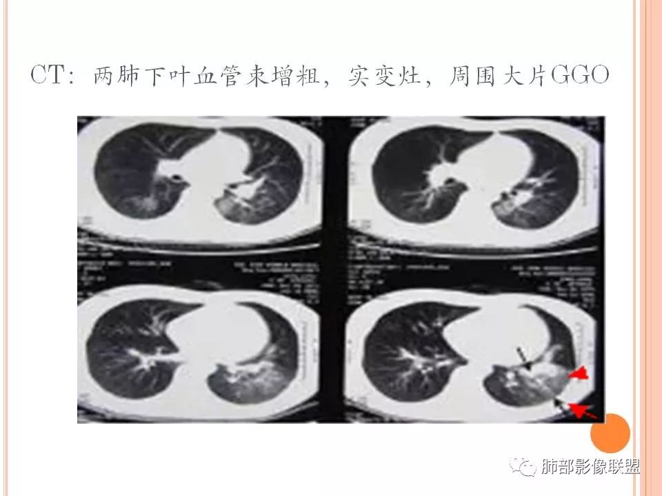 【PPT】支原体肺炎影像分析