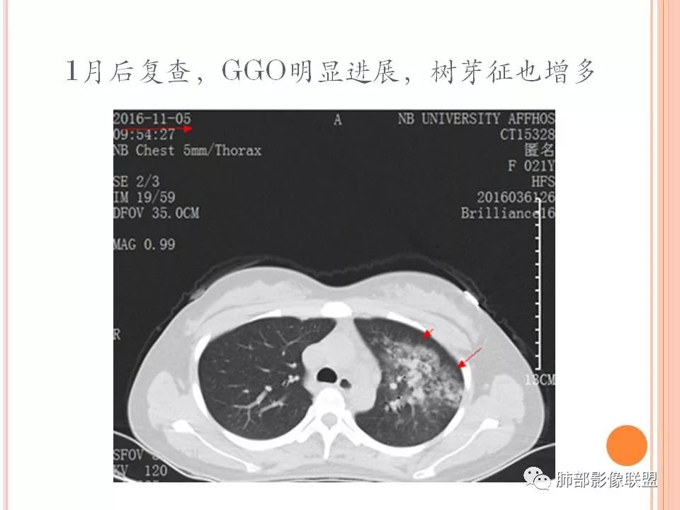 【PPT】支原体肺炎影像分析