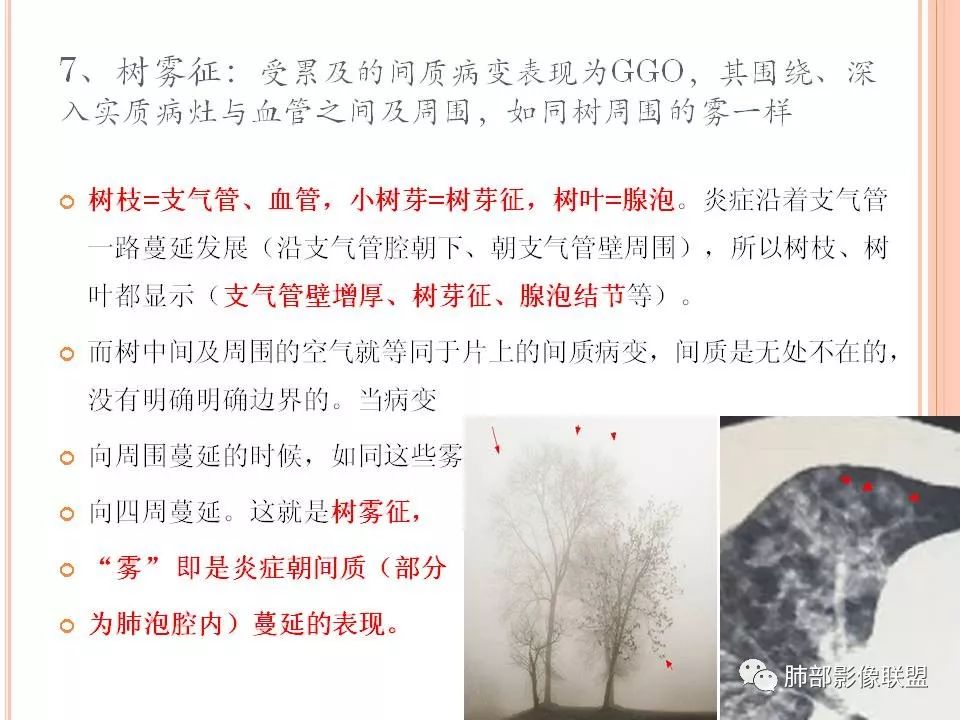 【PPT】支原体肺炎影像分析