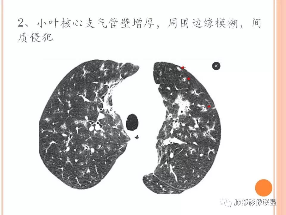 【PPT】支原体肺炎影像分析
