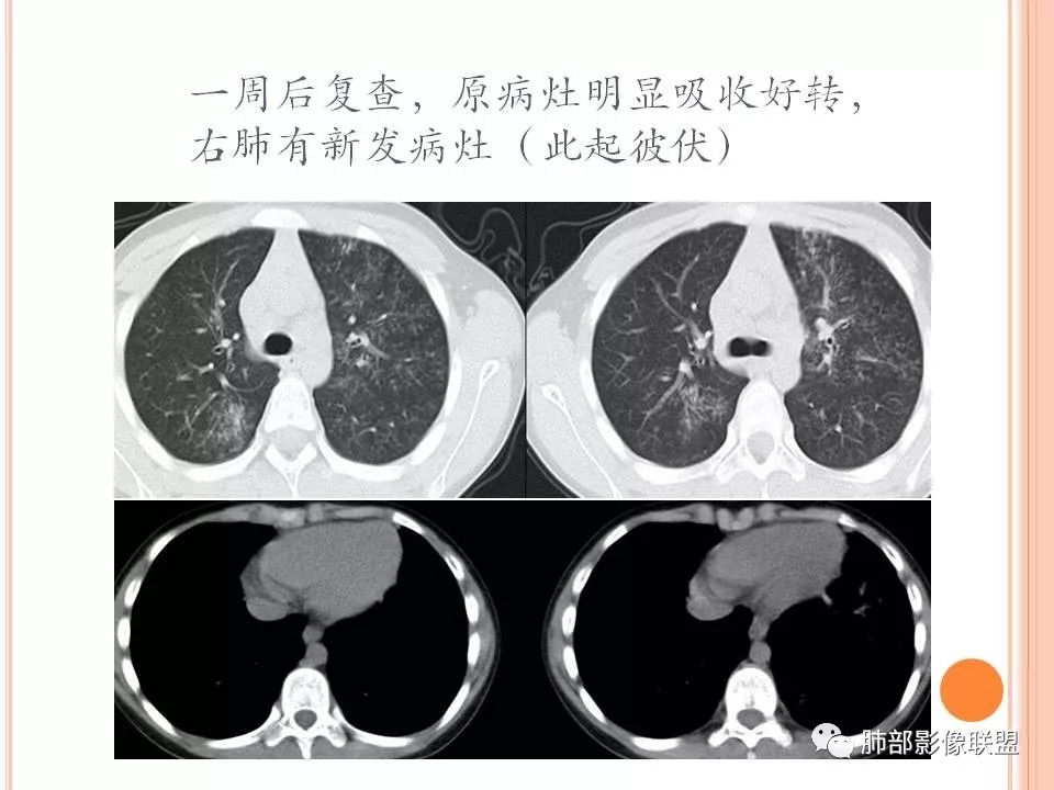 【PPT】支原体肺炎影像分析