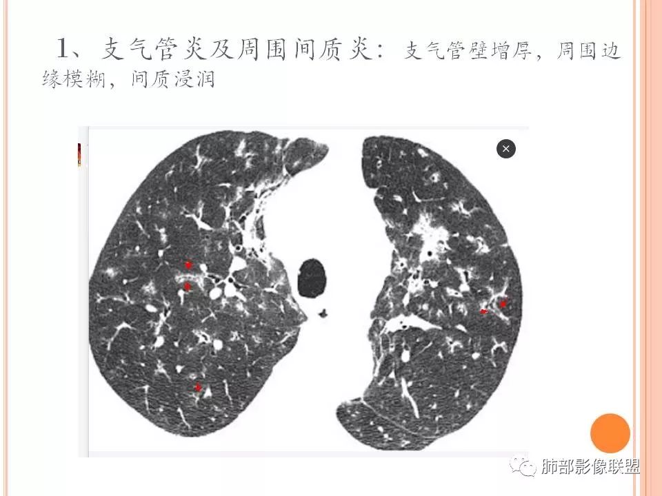【PPT】支原体肺炎影像分析