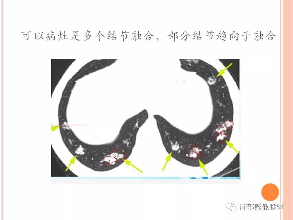 【PPT】支原体肺炎影像分析