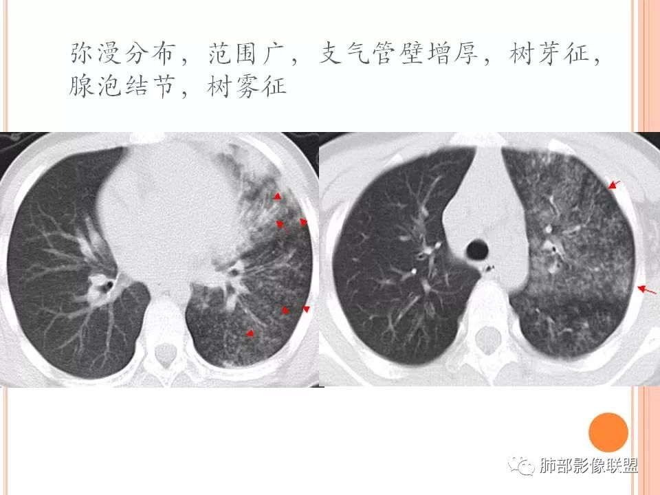 【PPT】支原体肺炎影像分析