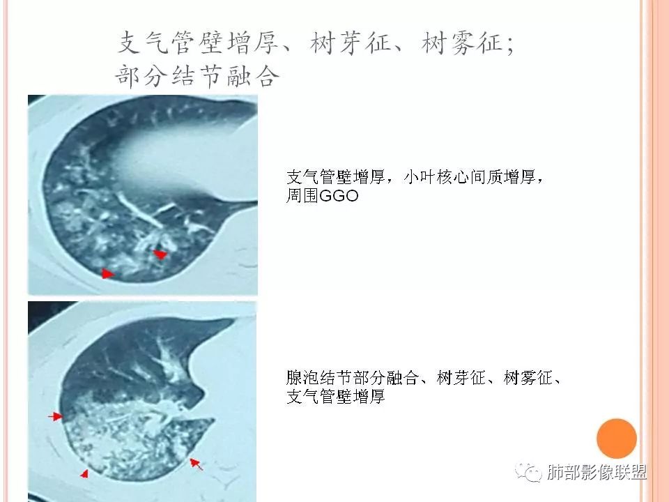 【PPT】支原体肺炎影像分析