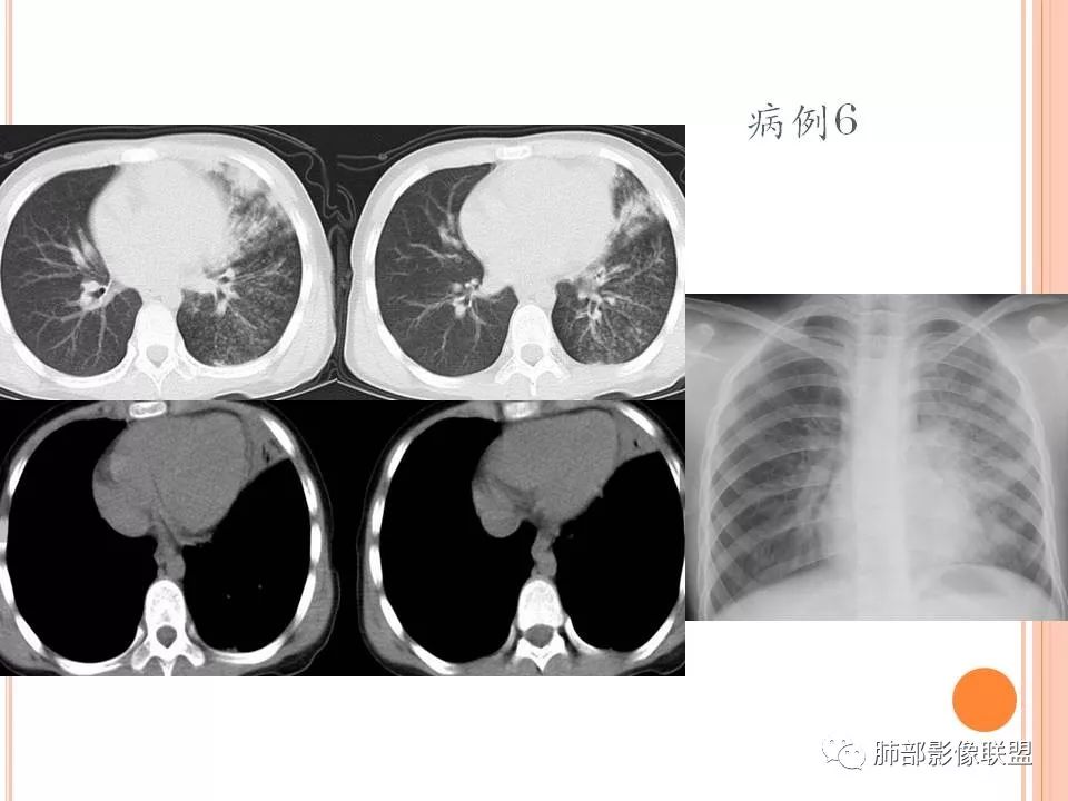 【PPT】支原体肺炎影像分析