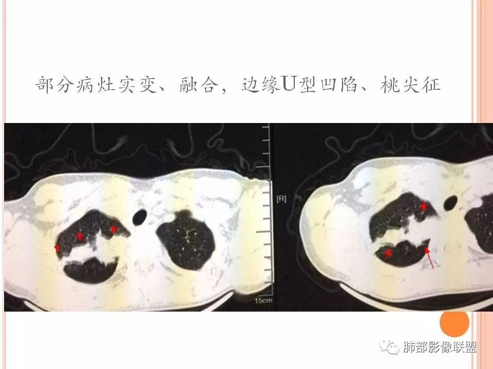 【PPT】支原体肺炎影像分析