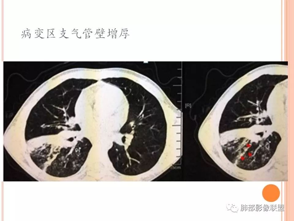 【PPT】支原体肺炎影像分析