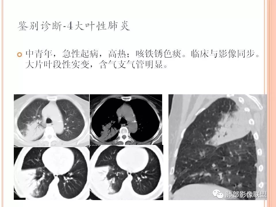 【PPT】支原体肺炎影像分析