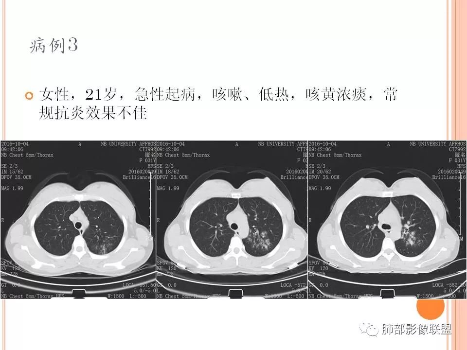 【PPT】支原体肺炎影像分析