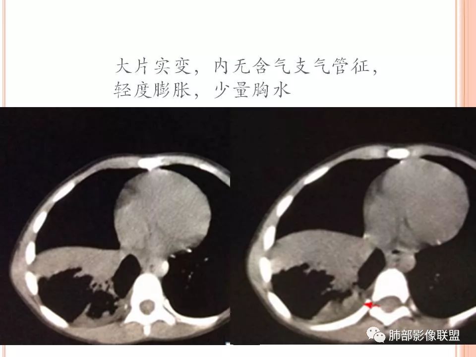 【PPT】支原体肺炎影像分析