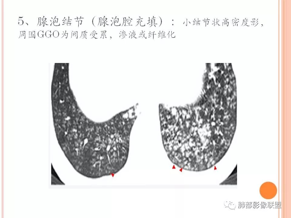 【PPT】支原体肺炎影像分析