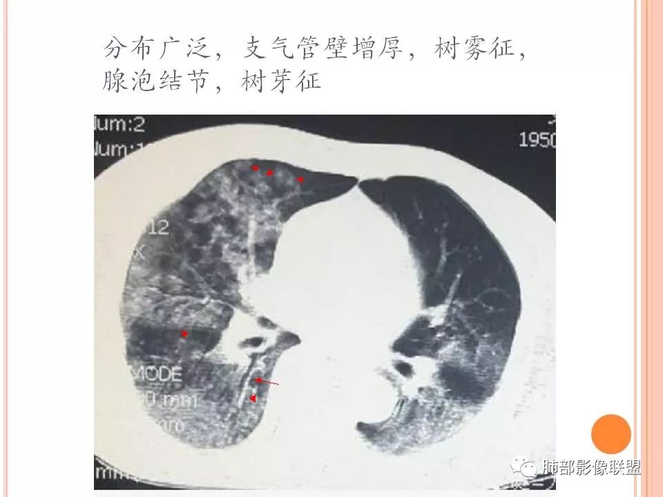 【PPT】支原体肺炎影像分析