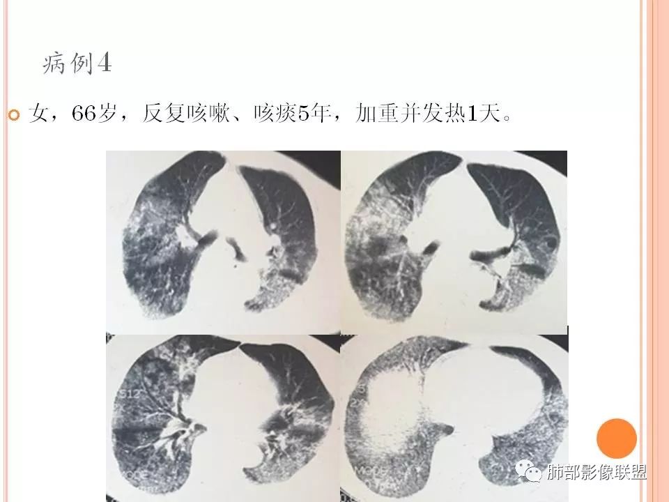 【PPT】支原体肺炎影像分析