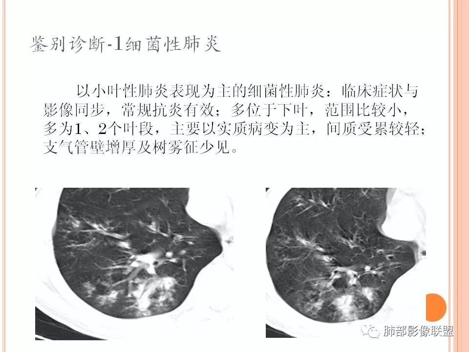【PPT】支原体肺炎影像分析