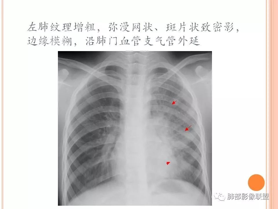【PPT】支原体肺炎影像分析