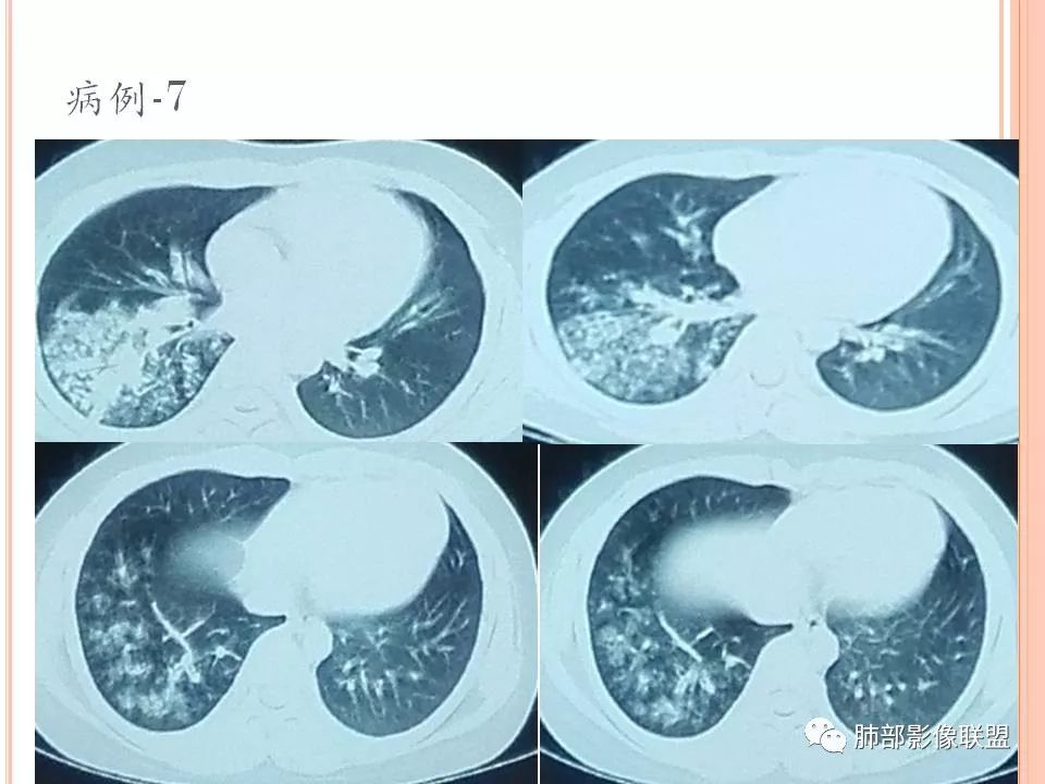 【PPT】支原体肺炎影像分析