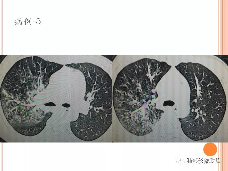 【PPT】支原体肺炎影像分析