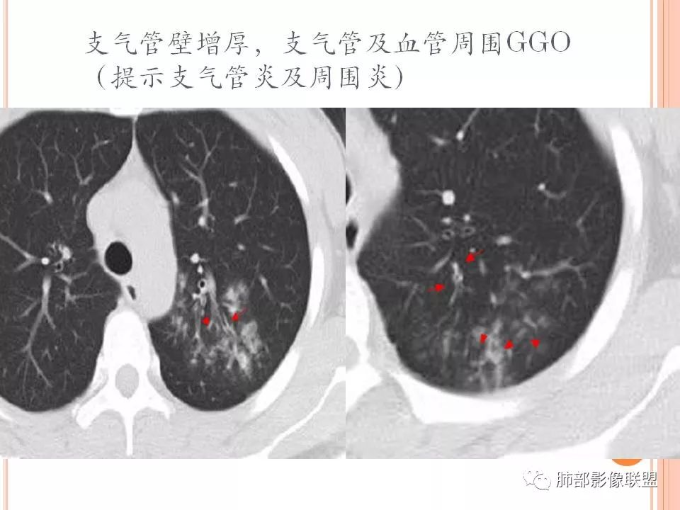 【PPT】支原体肺炎影像分析