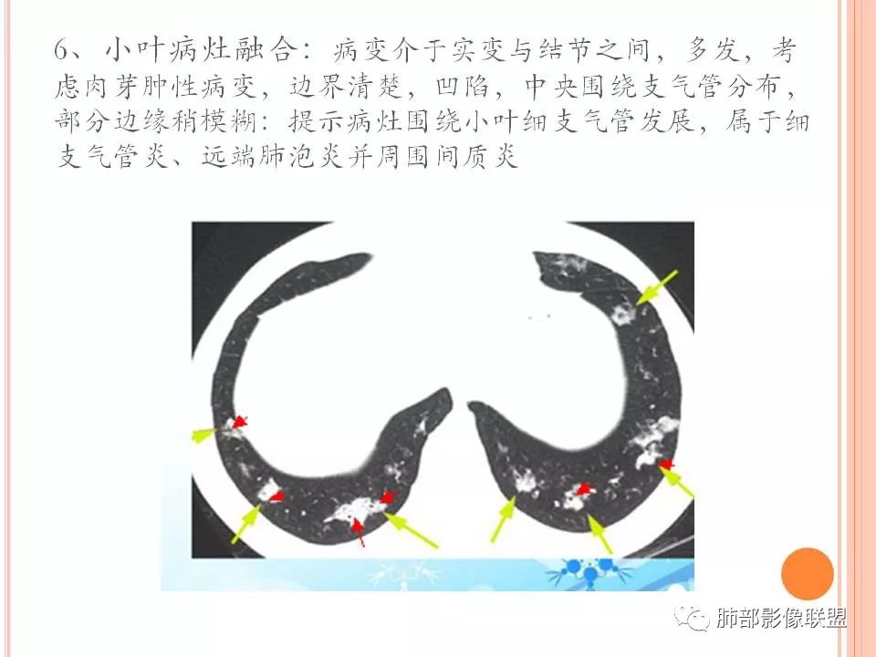 【PPT】支原体肺炎影像分析
