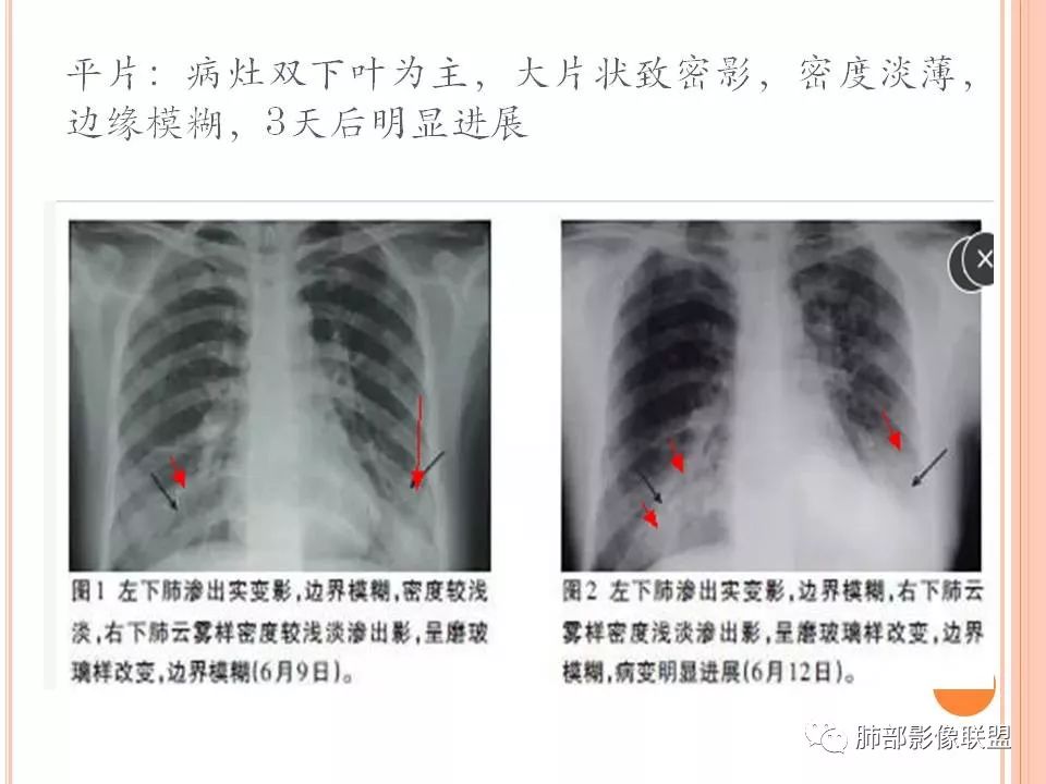 【PPT】支原体肺炎影像分析