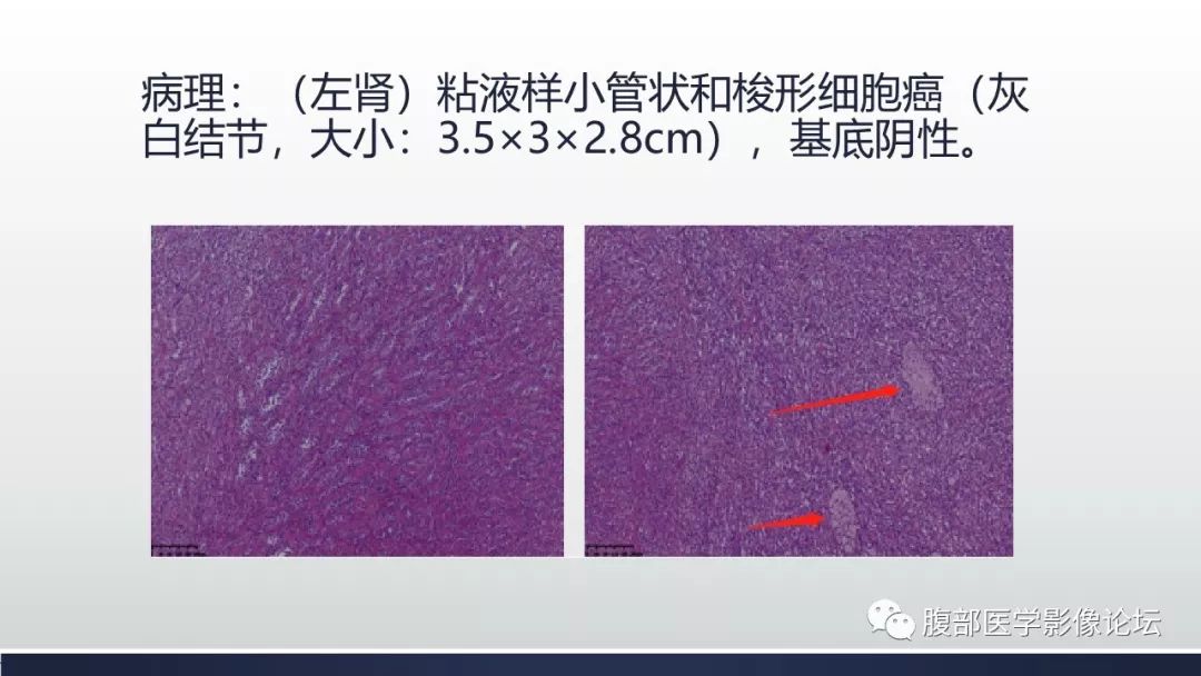 【病例】左肾混合性上皮间质肿瘤1例CT及MR影像