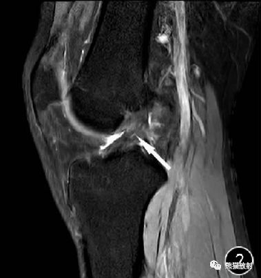 前交叉韧带损伤MRI 征象