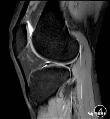 前交叉韧带损伤MRI 征象