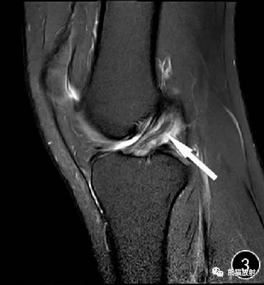 前交叉韧带损伤MRI 征象