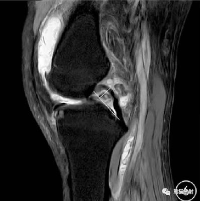 前交叉韧带损伤MRI 征象