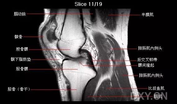 前交叉韧带损伤MRI 征象