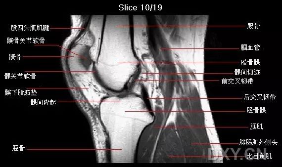 前交叉韧带损伤MRI 征象