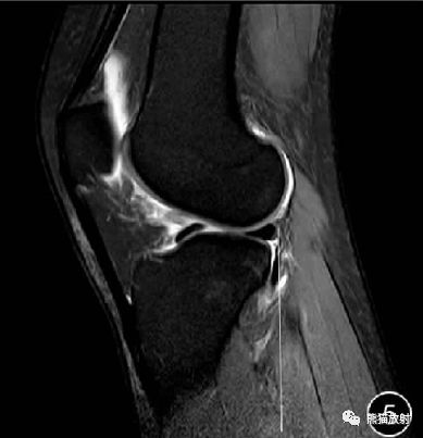 前交叉韧带损伤MRI 征象