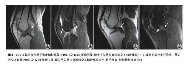 膝关节韧带正常解剖与损伤的 MRI 表现
