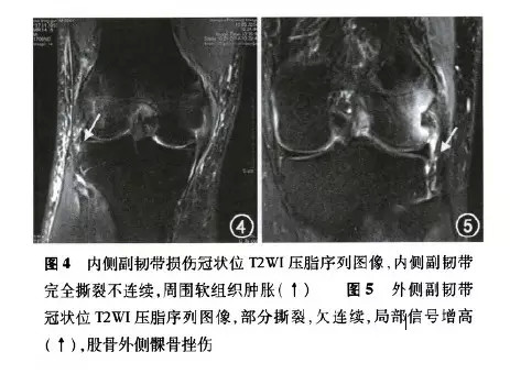膝关节韧带正常解剖与损伤的 MRI 表现