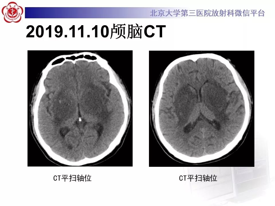【PPT】中毒性脑病的影像