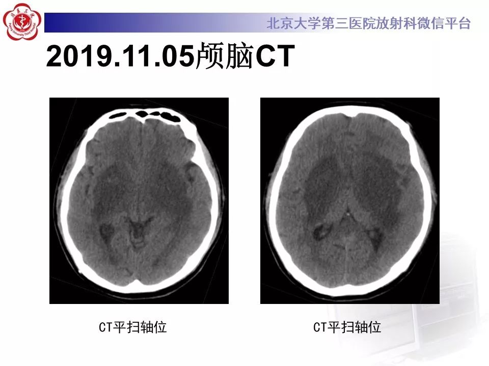 【PPT】中毒性脑病的影像