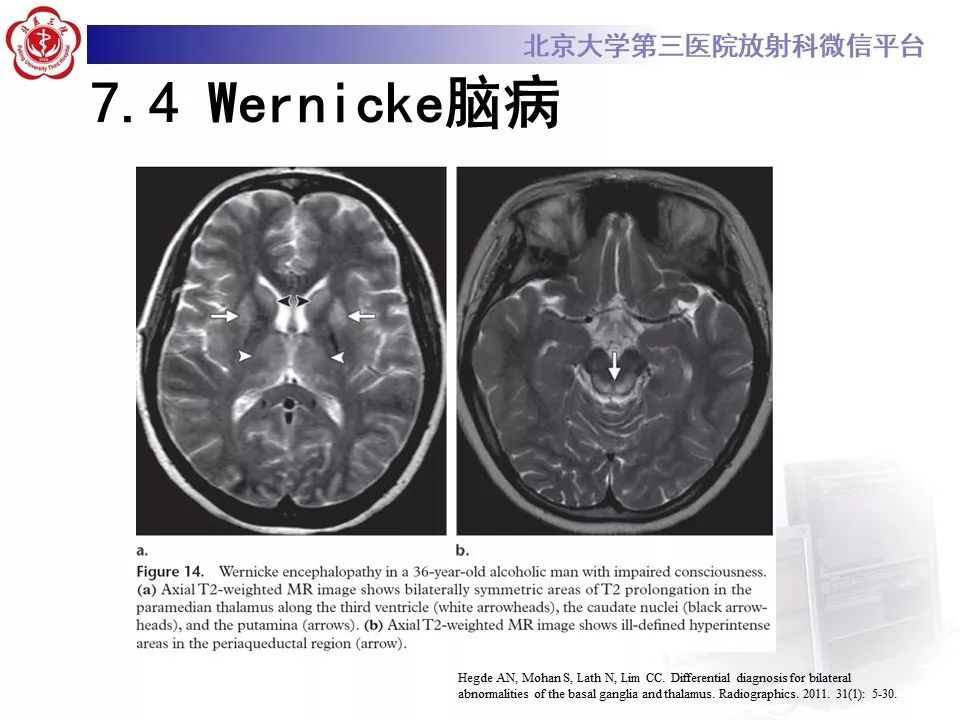 【PPT】中毒性脑病的影像