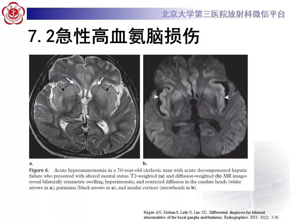 【PPT】中毒性脑病的影像