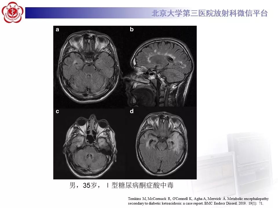 【PPT】中毒性脑病的影像