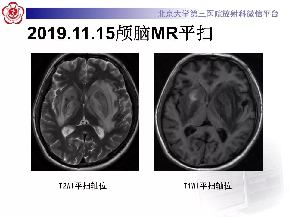 【PPT】中毒性脑病的影像