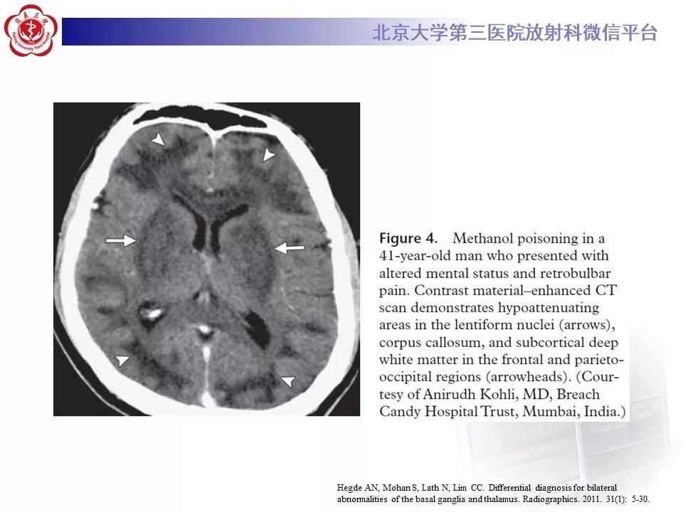 【PPT】中毒性脑病的影像