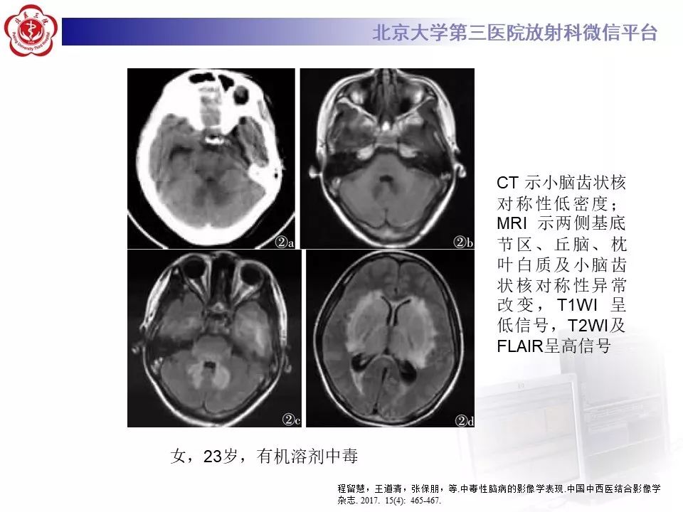 【PPT】中毒性脑病的影像