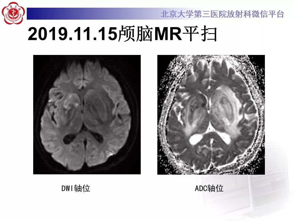 【PPT】中毒性脑病的影像