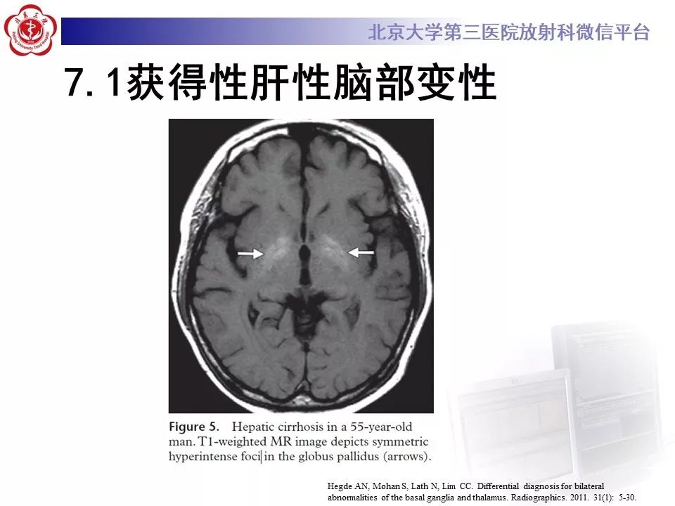 【PPT】中毒性脑病的影像