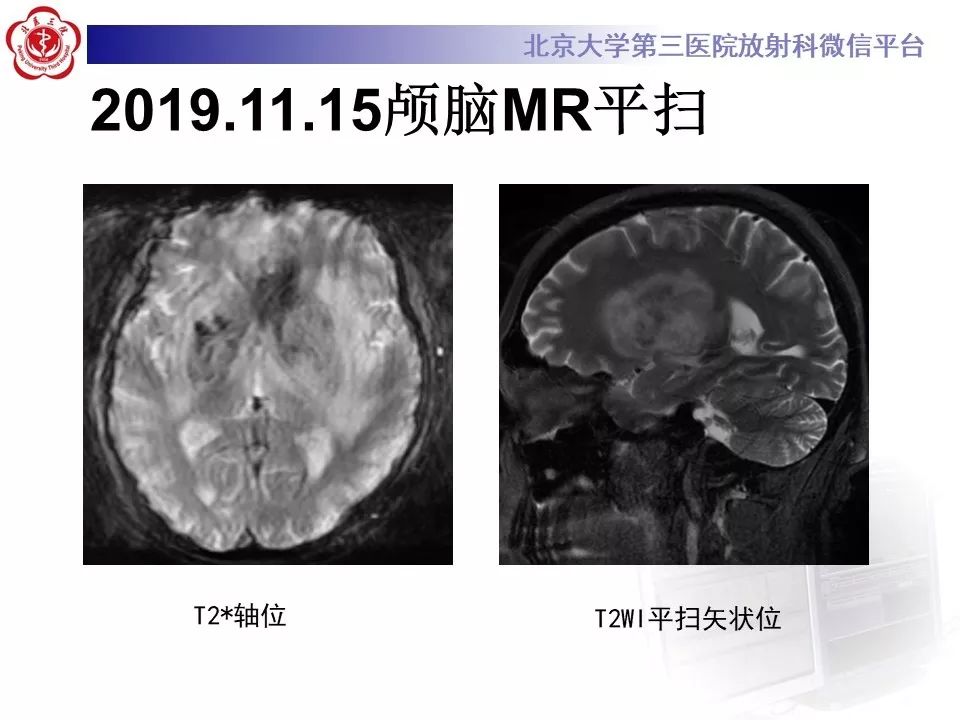 【PPT】中毒性脑病的影像
