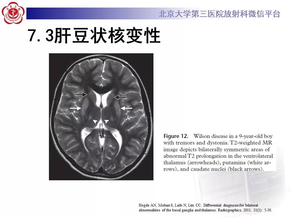 【PPT】中毒性脑病的影像